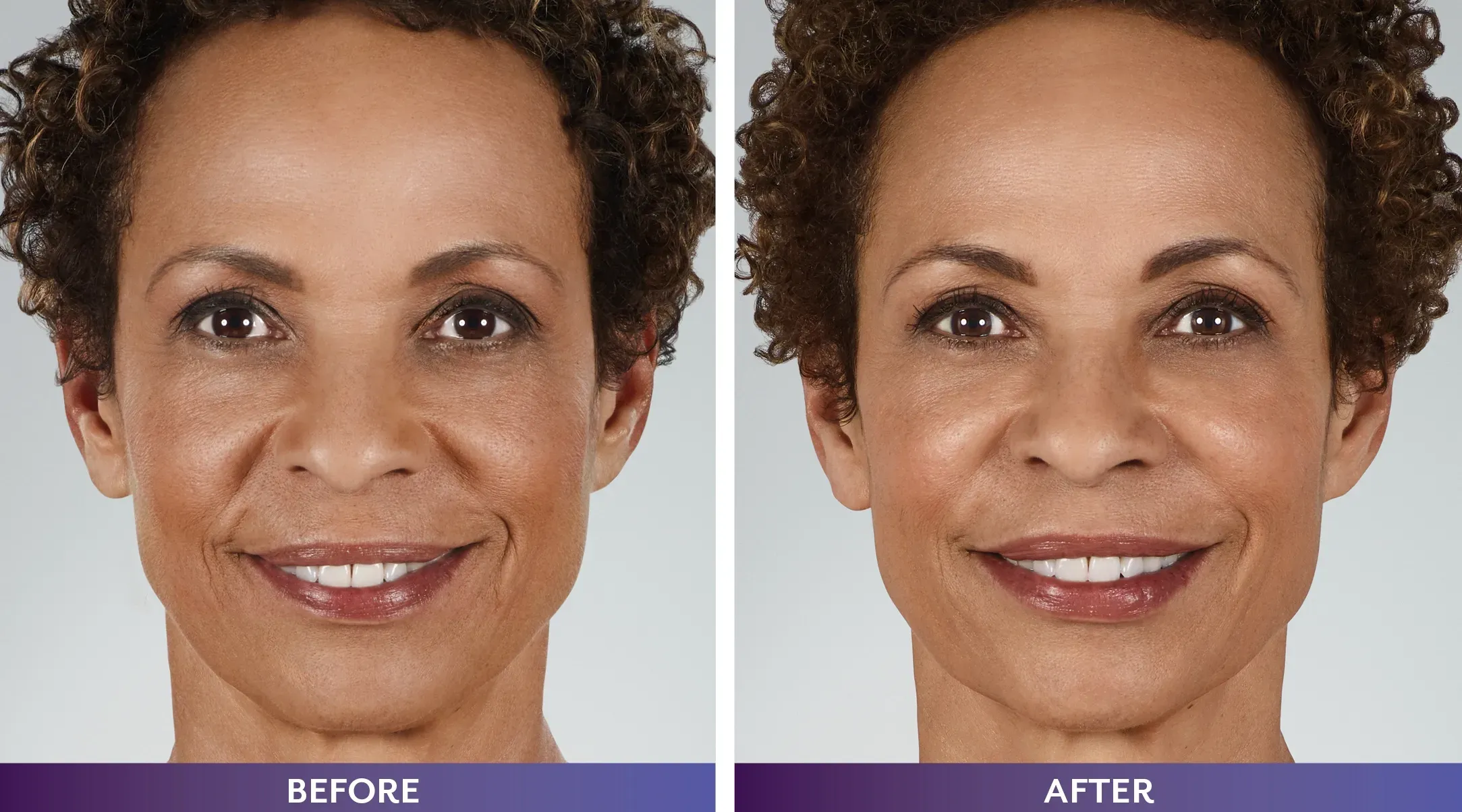 Natural-looking facial rejuvenation with dermal fillers in Mount Kisco NY