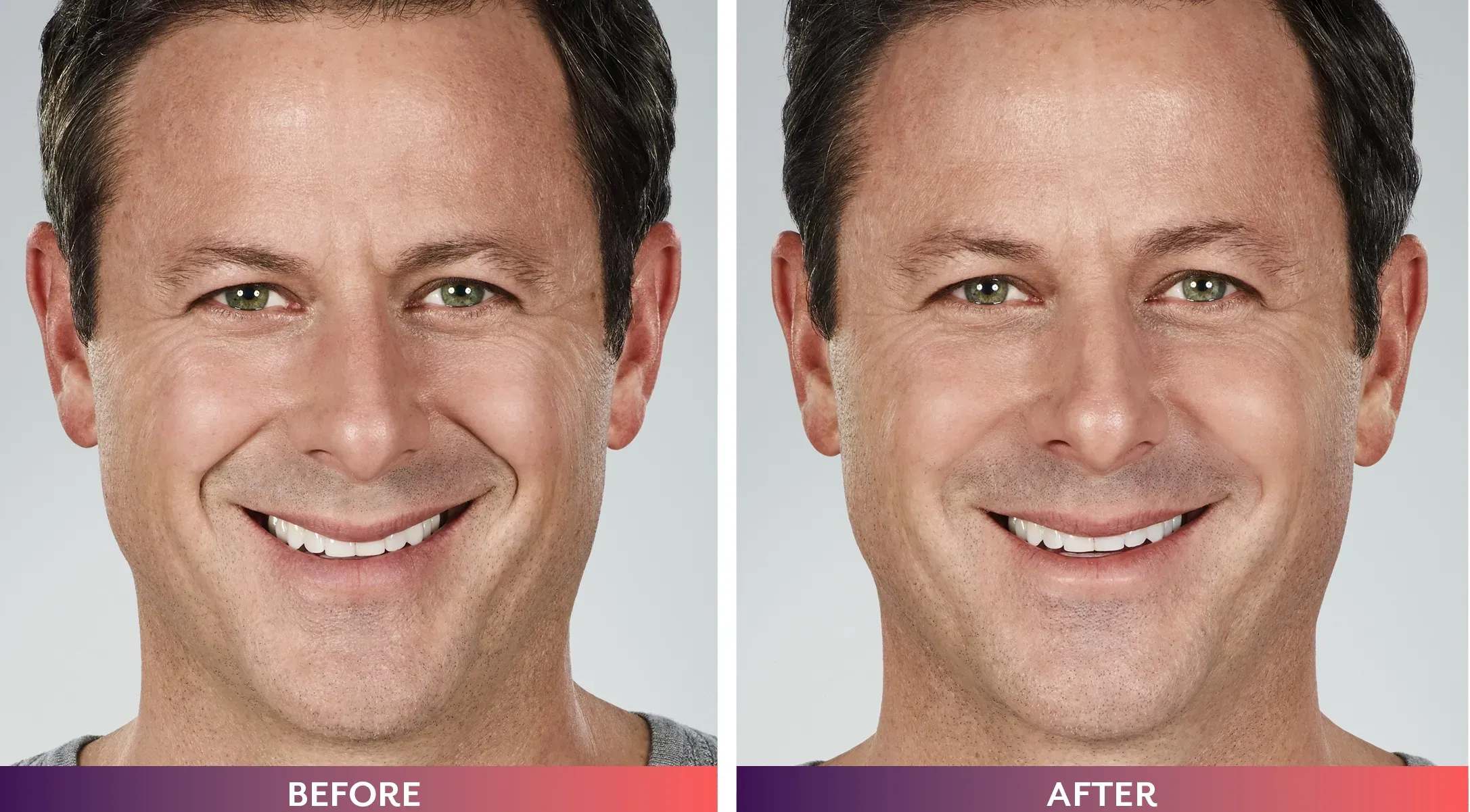 Cheek filler facial rejuvenation results in Mount Kisco NY