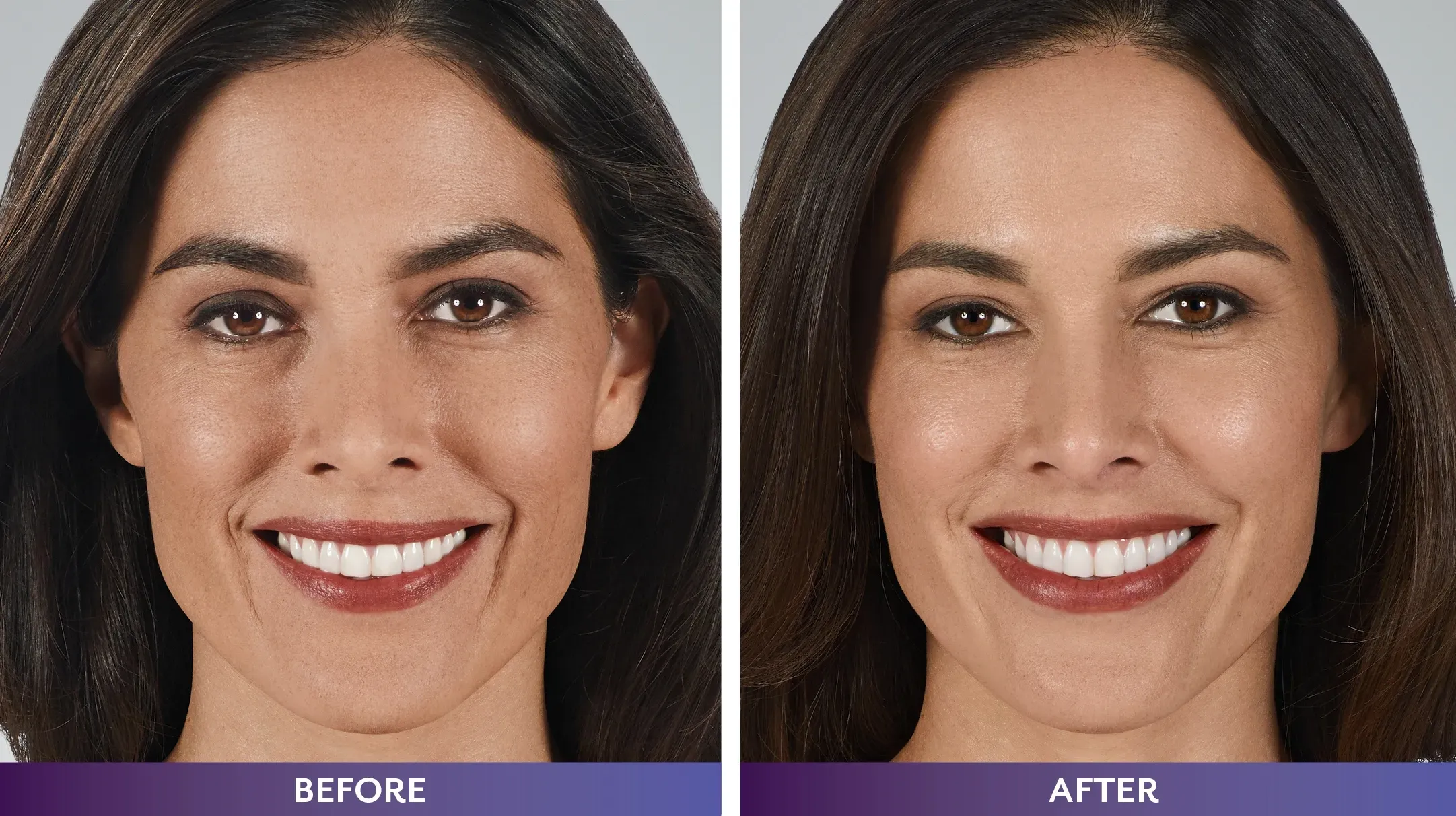 Lip filler enhancement results in Mount Kisco NY